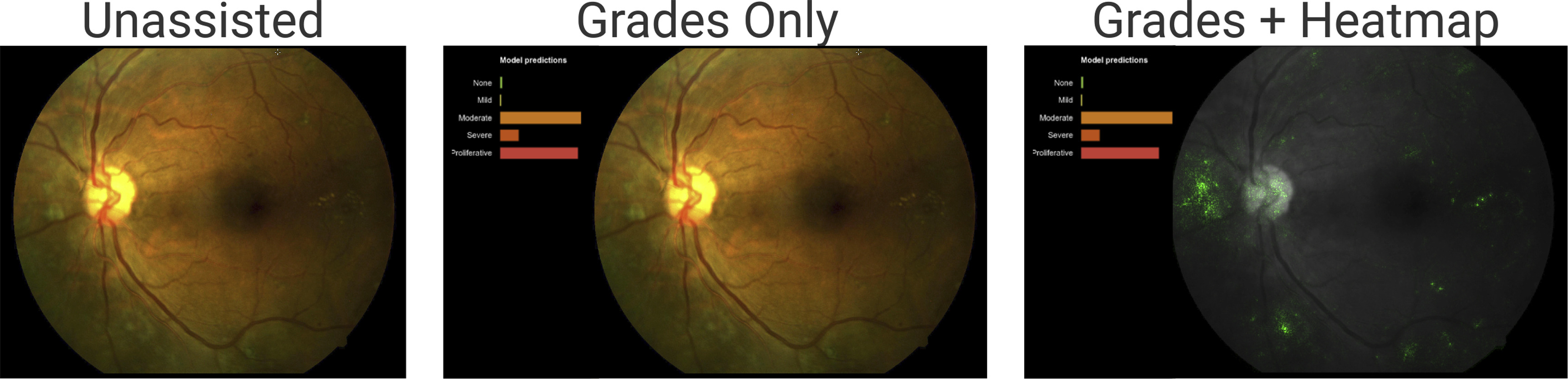 Using a Deep Learning Algorithm and Integrated Gradients Explanation to Assist Grading for Diabetic Retinopathy